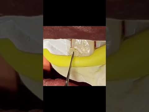 Cosmetic Bonding. A quick fix solution for chipped tooth. For appointment call - 7568221665