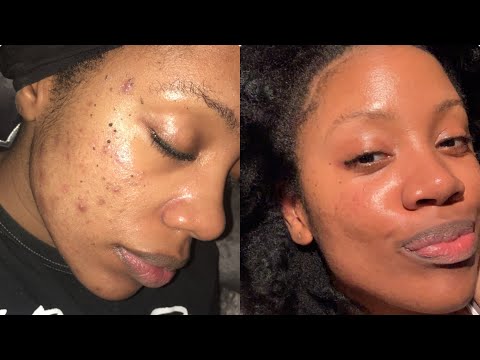 How to clear up sudden acne breakouts fast (for Acne Prone Combination Skin)