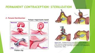 FAMILY PLANNING/ Birth control methods