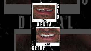 Amazing Smile Transformation: Before and After by Dr. Lee | GLO Dental Group