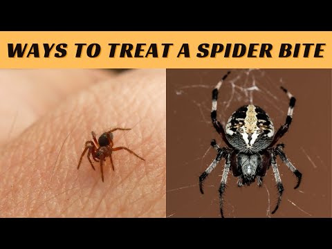 Easy ways to treat a spider bite | How to treat a spider bite
