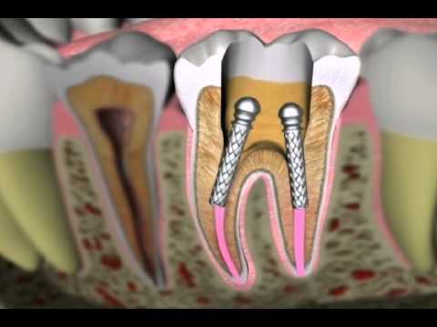 Endodontics - Root Canal Therapy