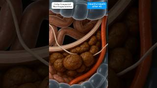 Colon Animation of Dark-Brown Compacted Stool Mass Breaking Under Peristalsis #shorts #youtubeshorts