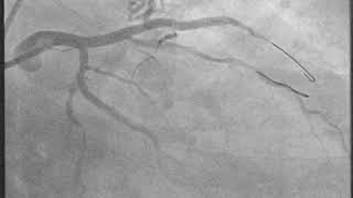 LAD – PCI 4