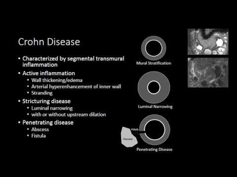 Small Bowel Inflammation