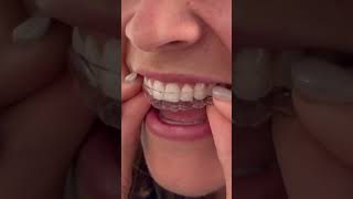 Bonded Retainers On Upper Teeth 🦷 #braces #retainer #orthodontist