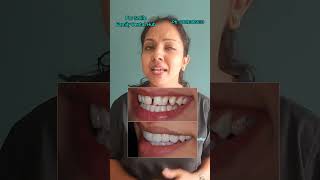 Experience the magic of smile correction#smiledesigning #smilecorrection #