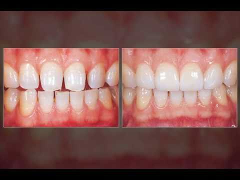 Veneers - Closing Space Between Teeth