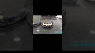 Digital Dentistry + zirconia crowns | Microdent Dentistry, Kothrud, Pune