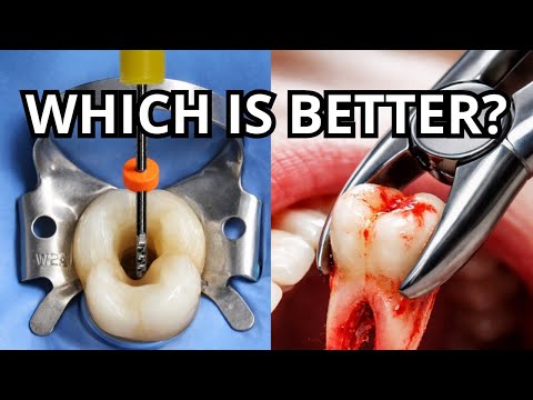 Root Canal or Extraction? The Wrong Choice Can Cost You
