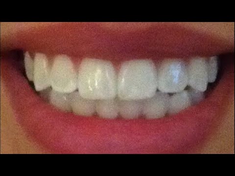 dental arches