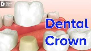 Dental Crown | Types, Procedure, Material