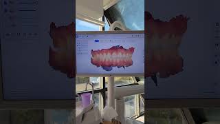 Kavala Dent - Digital impression after orthodontic treatment for retainers #kavaladent #shining3d