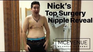 FTM Top Surgery Reveal | McLean Clinic