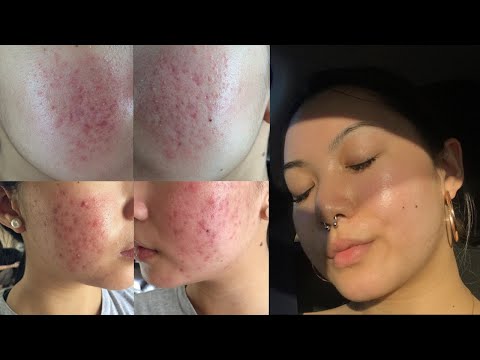 How I Cured My Hormonal Teen Acne