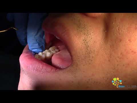 Implant Crown