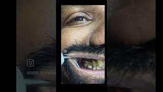 #tamil #tamildentist #dentistinchennai #dentalcareinperambur #dentistry #bestdentalclinicchennai