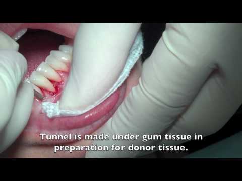 Gingival Graft 1