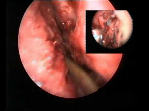 Problemas en la cirugía de la epistaxis / Problems during surgery for epistaxis