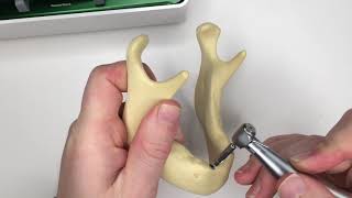 Hero Implants - Removing a dental implant