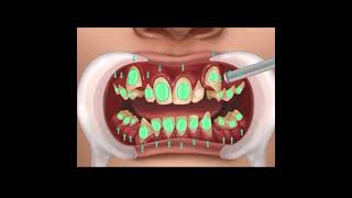 hygienic clean teeth#dentalhealthcare #dentalveneer #dentalmakeover