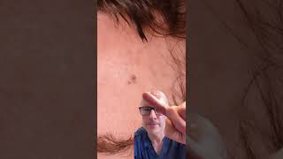Early Stage Melanoma: A Life-Saving Detection