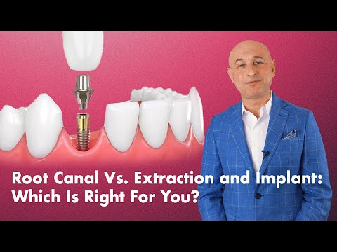 Root Canal Vs. Extraction and Implant: Which Is Right For You?