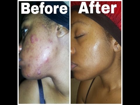 How I got rid of my adult acne(skin care routine)