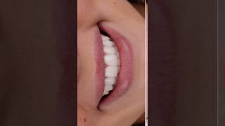 Smile Enhancement with Porcelain Veneers 🔥🔥 #new #smile #smilemakeover