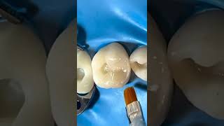 Class 2 composite restoration for upper first molar #cavity #dentist #amalgam #composite