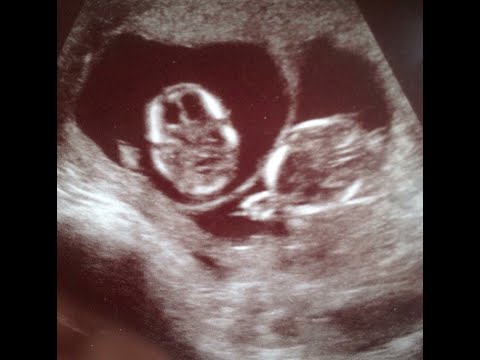 IVF - Dreams Do Comes True
