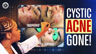 Cystic Acne Rosacea Before & After Using Morris Code Beauty Advanced Aesthetics Skin Care Products!