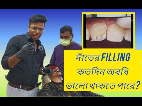 দাঁতের filling কতদিন অবধি ভালো থাকতে পারে? #dentalfilling #dentalcare #healthtips