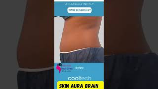 #cooltech #fatfreezing #coolsculpting #fatloss