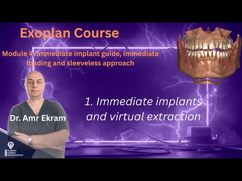1  Immediate implants and virtual extraction Exoplan (1/6)