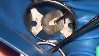 Pulpotomy in an Adult Tooth