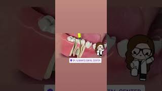 #rootcanal #rct #dentistry #dentist #endodontics #rootcanaltreatment #dental  #rootcanalspecialist