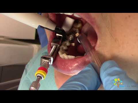 Cavity Filling with Dental Cleaning