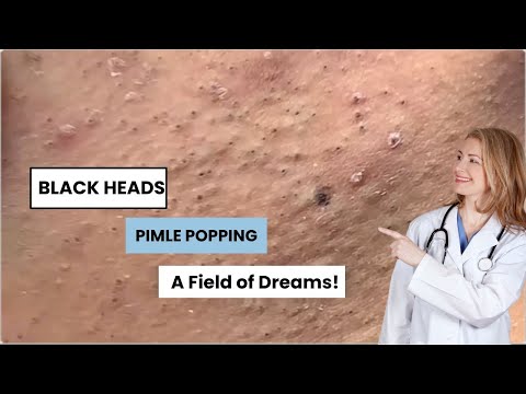 Satisfying Relax  Blackheads  Popping | PIMPLE SPA