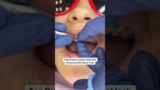 Top Braces Colors that look Amazing with Black Hair