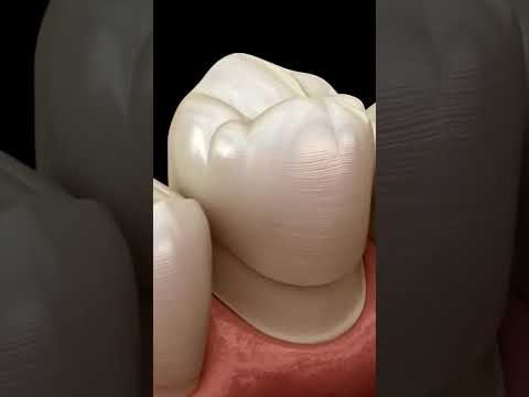 Animated Dental Crown Procedure