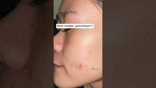 PEJUANG SEMBUH DARI JERAWAT #jerawat #pejuangjerawat #bekasjerawat #halodoc