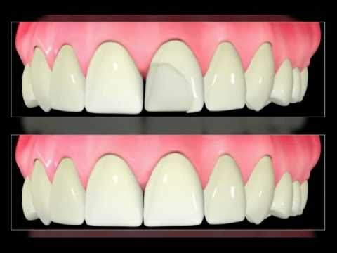 Veneers - Chipped Veneer