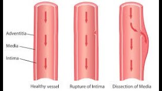 Dissection CPT code - simplify medical coding