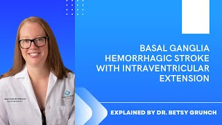 Case study 49 - Basal Ganglia Hemorrhagic Stroke with Intraventricular Extension