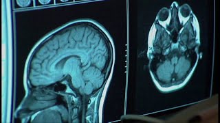Pre-clinical trial underway locally to identify biomarker for Alzheimer's disease