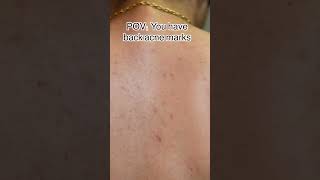 How To Prevent Back Acne? | Dr. Sarin |