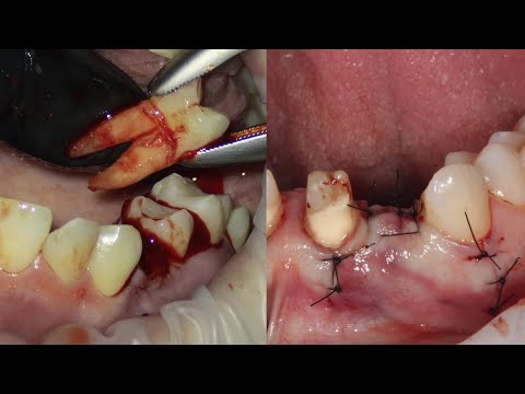 Tooth extraction live – full unedited video! Watch if you dare!
