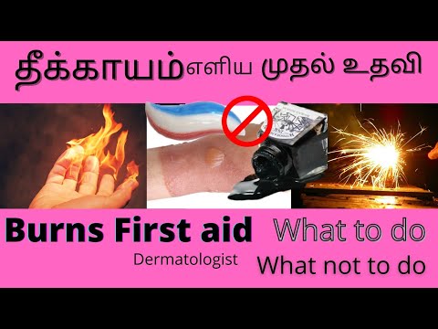Burns first-aid/cracker burns/ scalds/ தீக்காயம் ஏற்பட்டால் என்ன செய்ய வேண்டும்?