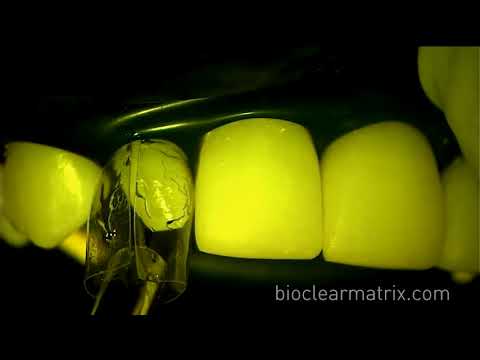 Bioclear Composite Veneers for Undersized Teeth  Part 2